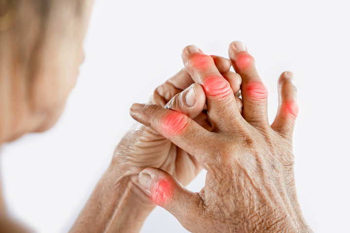 How rheumatoid arthritis can be delayed or even prevented